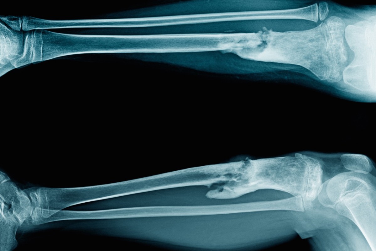 Osteomielitis, Penyakit Infeksi Pada Tulang